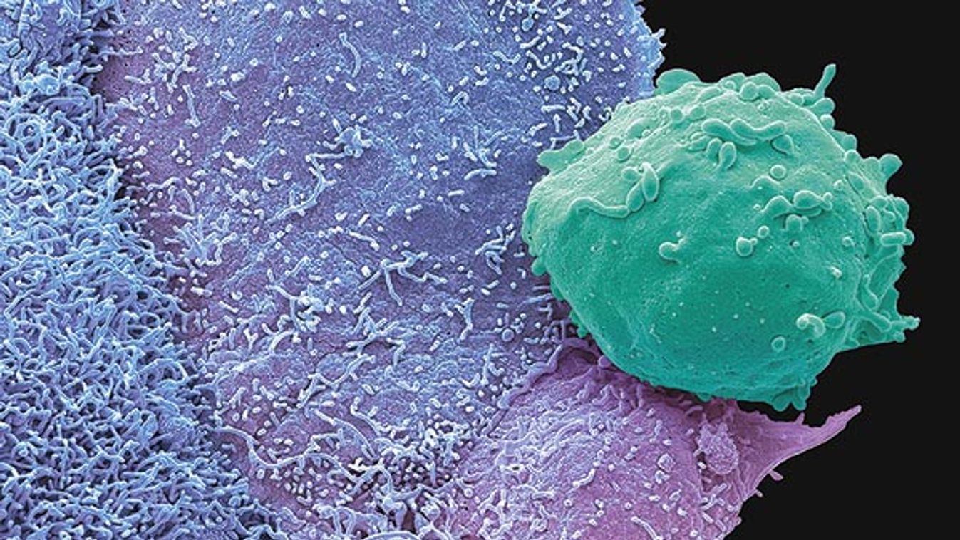 Cancer cells and monocyte, SEM