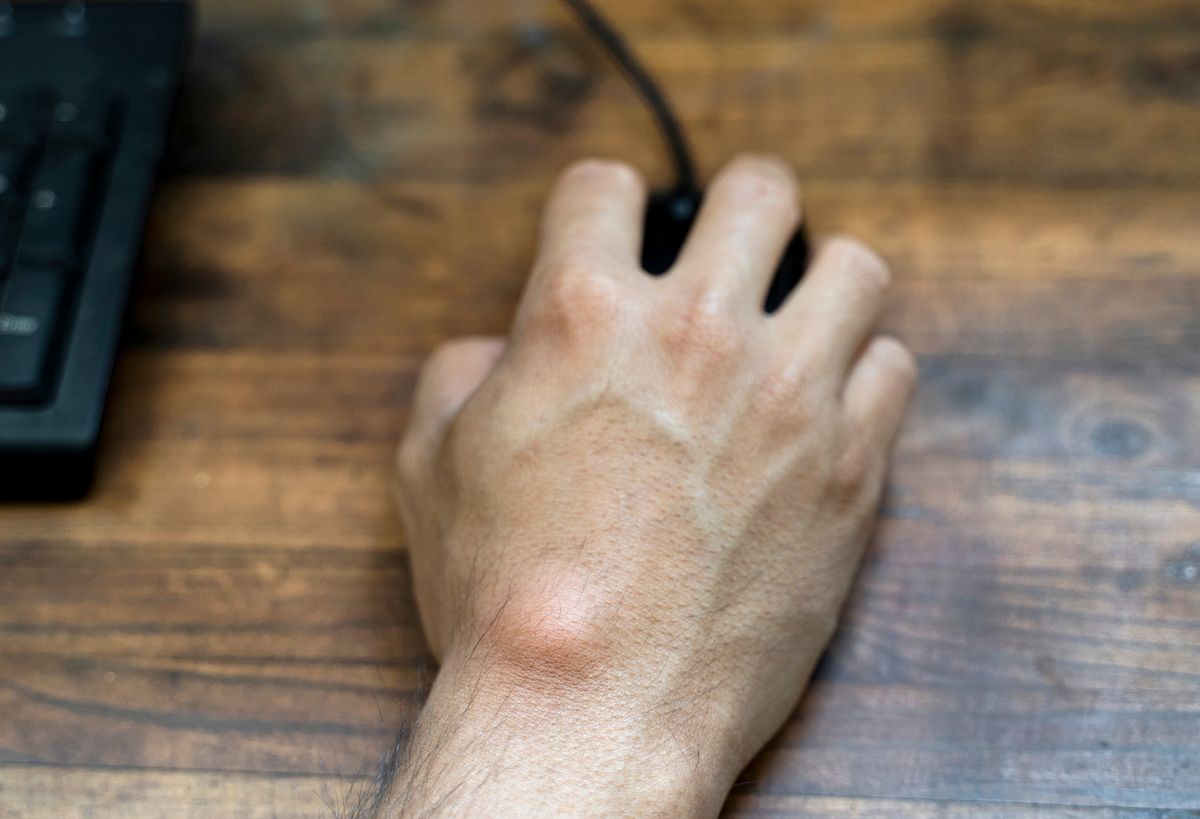 Ganglion,Cyst,On,Man's,Hand.,Hand,Holding,Computer,Mouse.