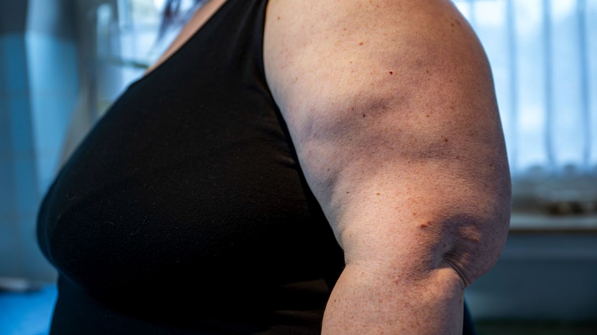 Rare diseases: Lipedema